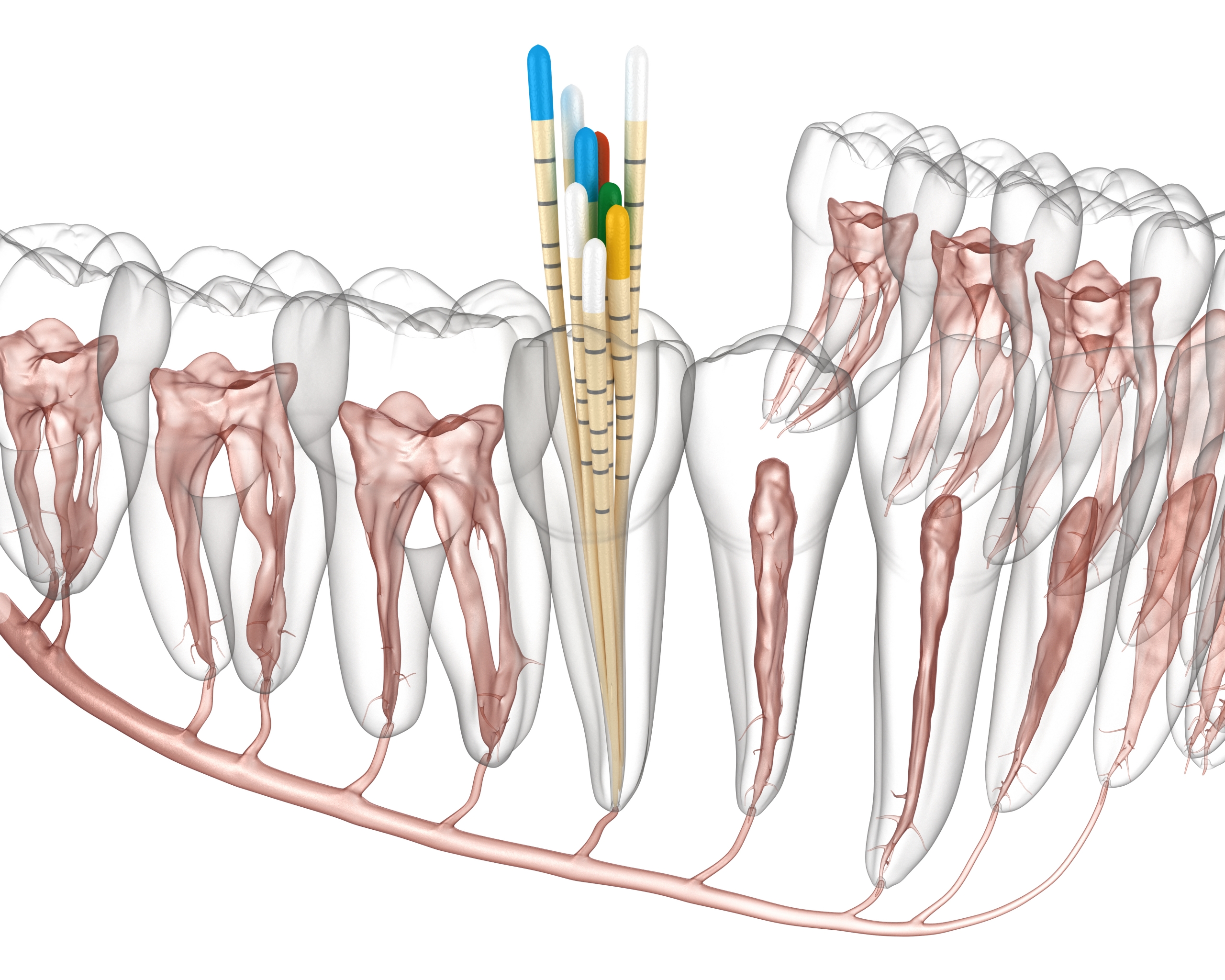 Endodontic,Root,Canal,Treatment,Process.,Medically,Accurate,Tooth,3d,Illustration.